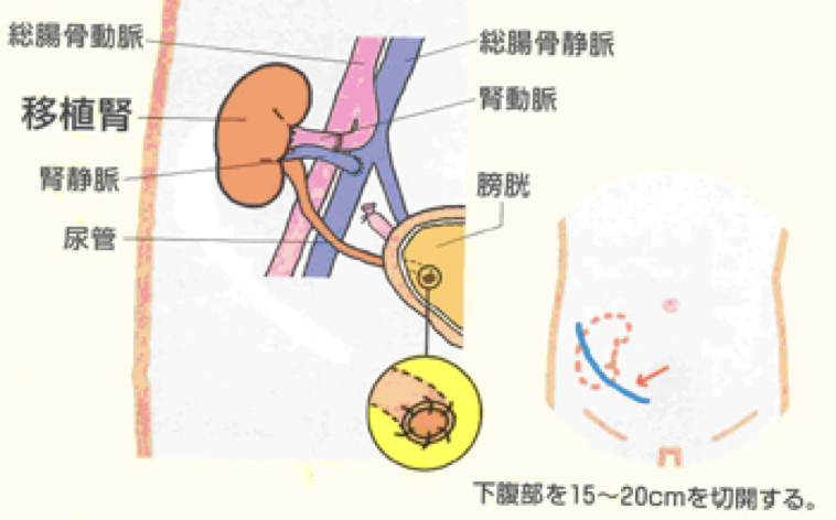 腎移植
